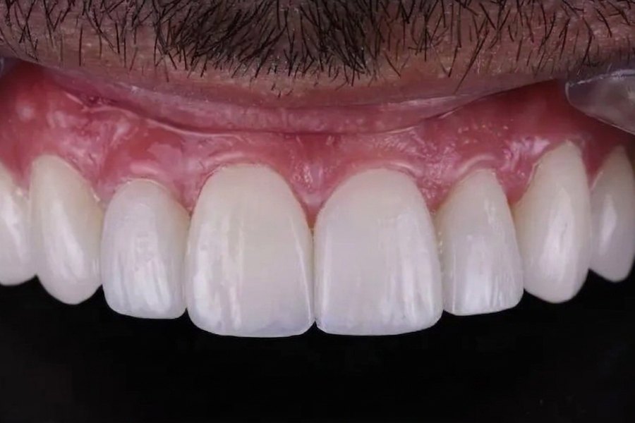 Diseño de sonrisa en cerámica